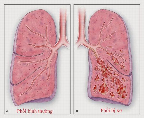 Phân biệt phổi bị xơ và bình thường